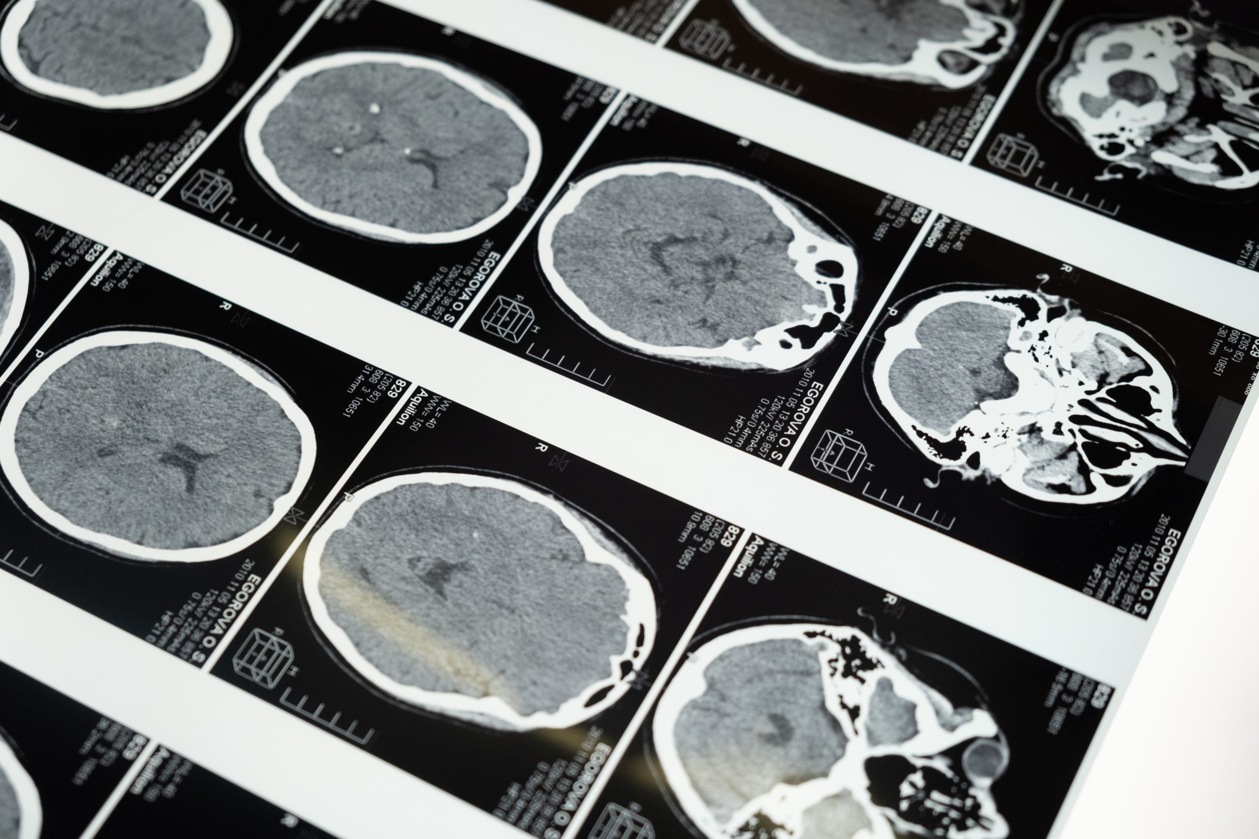 Xerrada «Alzheimer. Com es tracta a nivell mèdic»